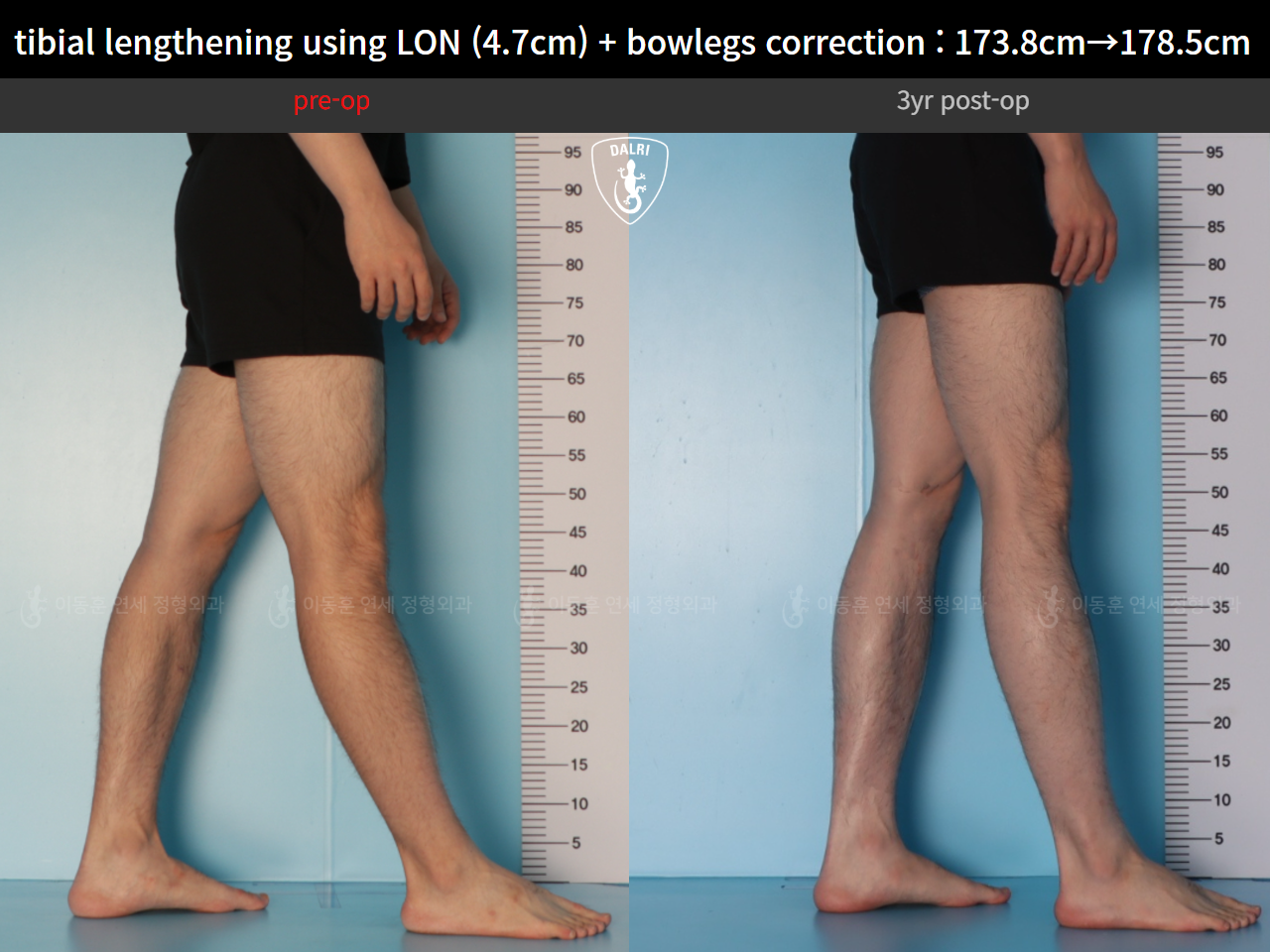 Before and after cll + deformity correction, case 128582896, image 9, Dr. Donghoon institute (DALRI)