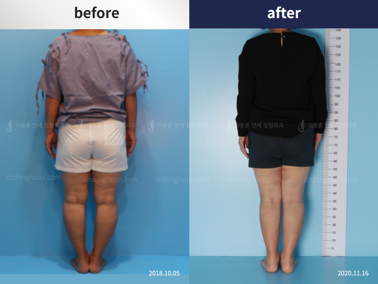 Before and after osteotomy for knee osteoarthritis, case 5346296, image 3, Dr. Donghoon institute (DALRI)