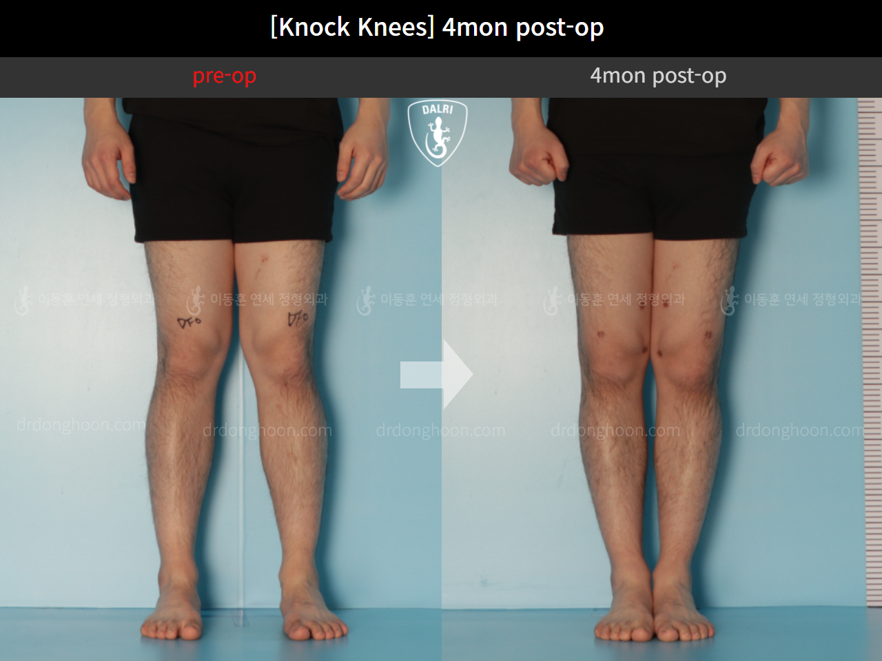 Before and after adult knock knees, case 10599771, image 5, Dr. Donghoon institute (DALRI)