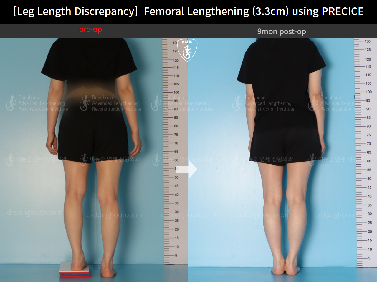 Before and after adult lld, case 14602297, image 2, Dr. Donghoon institute (DALRI)