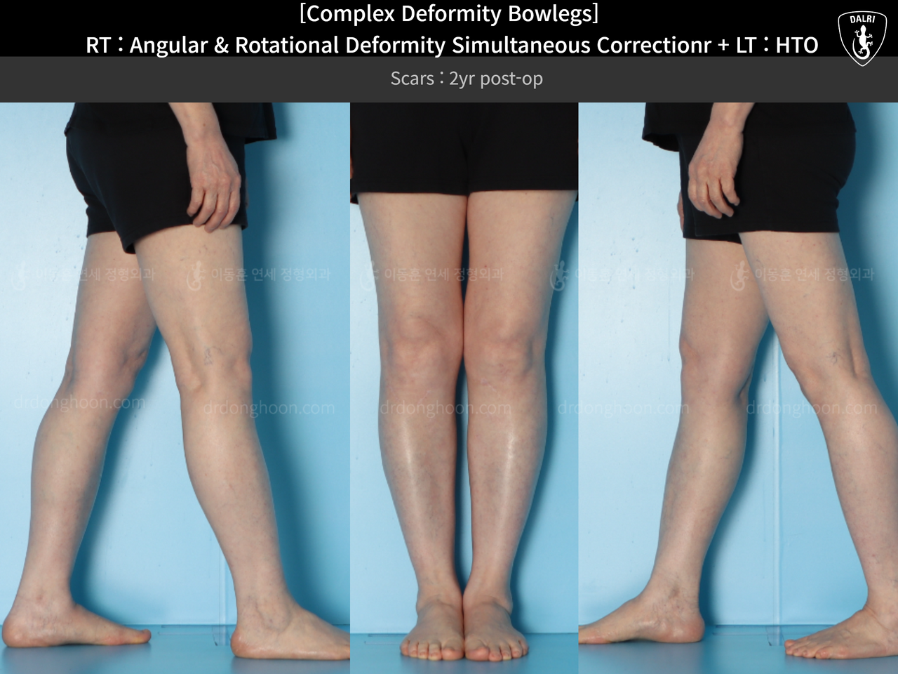 Before and after adult bowlegs, case 14328178, image 4, Dr. Donghoon institute (DALRI)