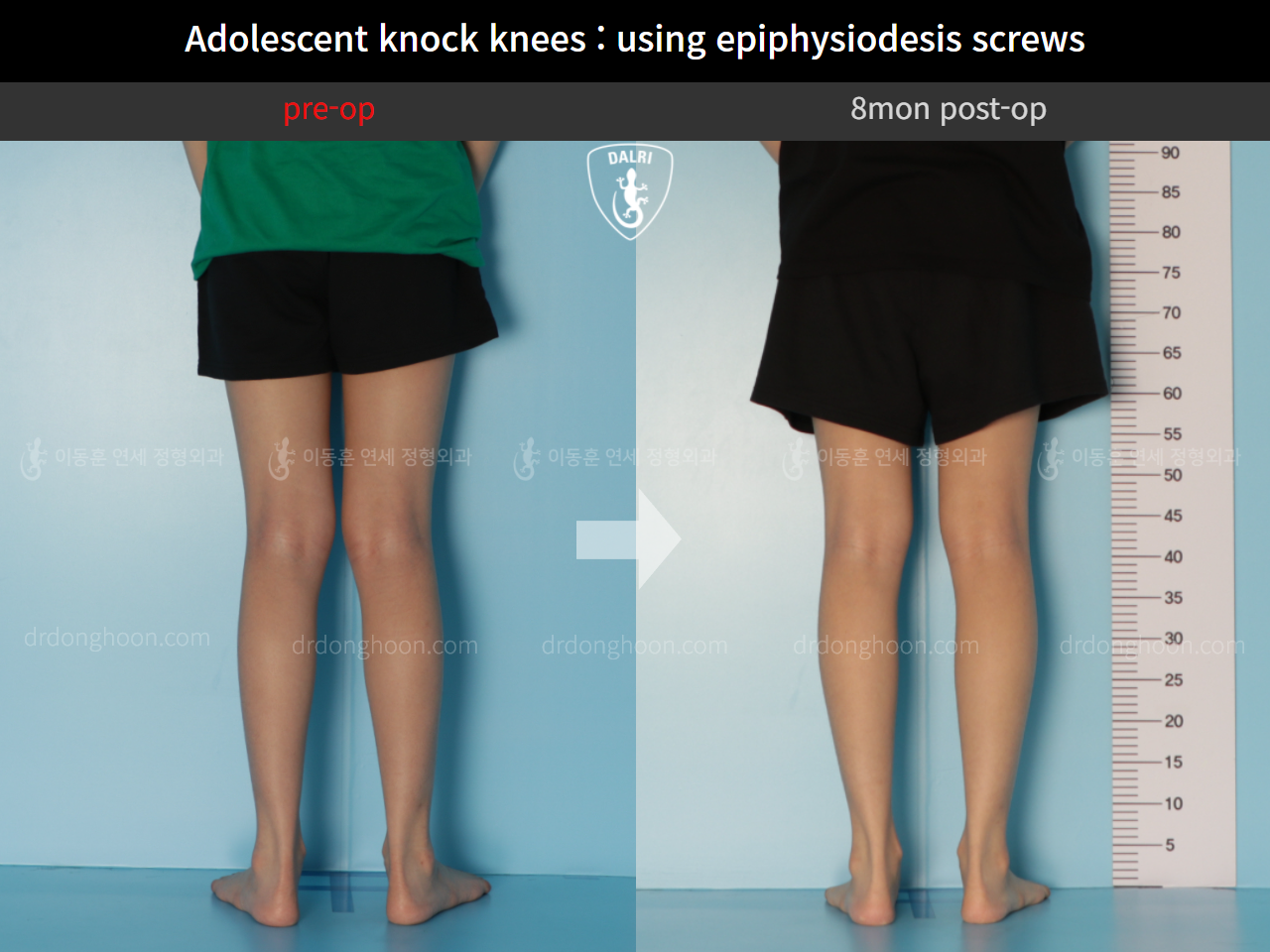 Before and after paediatric & adolescent knock knees, case 10451470, image 3, Dr. Donghoon institute (DALRI)