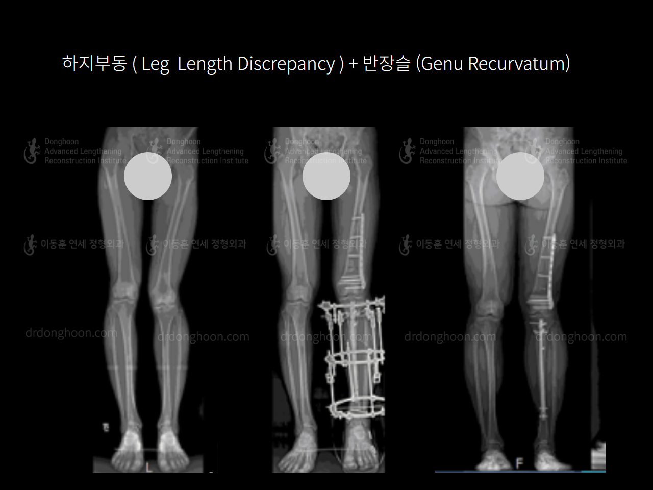 Before and after genu recurvatum, case 4250803, image 3, Dr. Donghoon institute (DALRI)