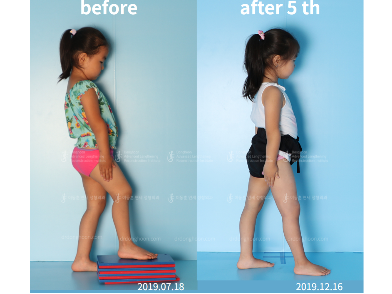 Before and after paediatric & adolescent lld, case 4577152, image 5, Dr. Donghoon institute (DALRI)