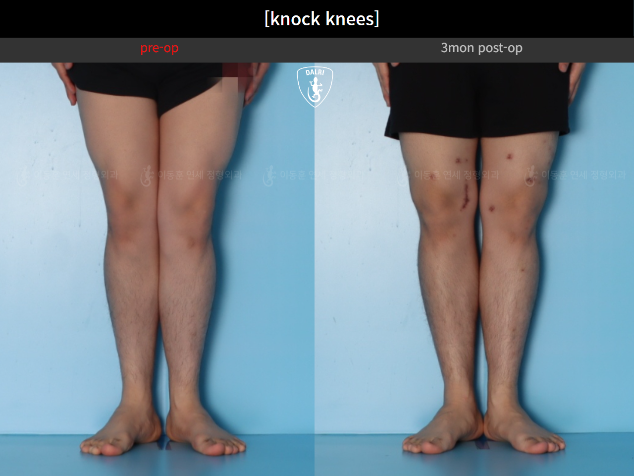 Before and after adult knock knees, case 124642361, image 6, Dr. Donghoon institute (DALRI)