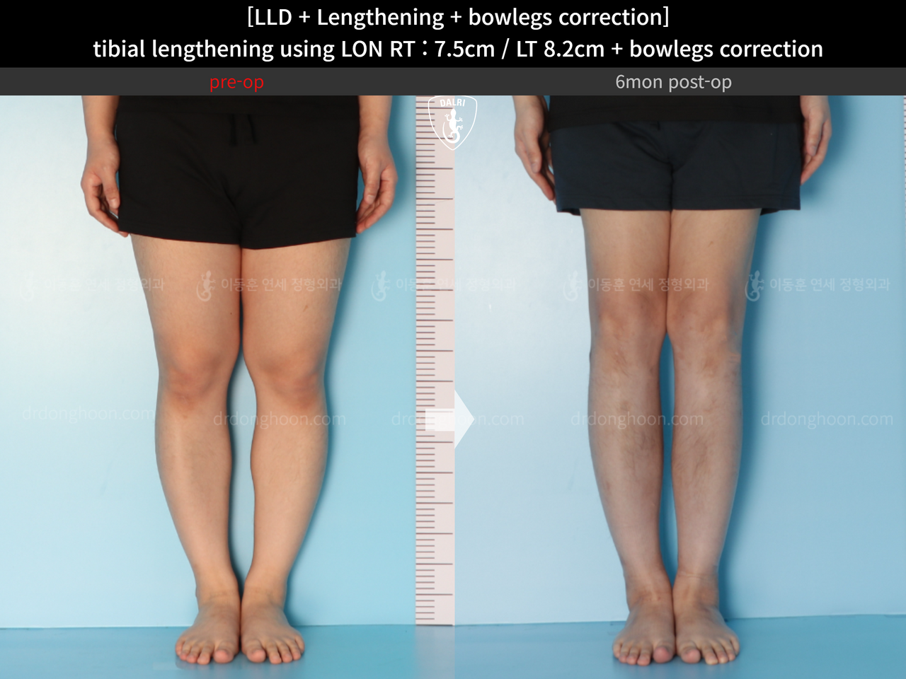 Before and after cll lon, case 14399776, image 3, Dr. Donghoon institute (DALRI)
