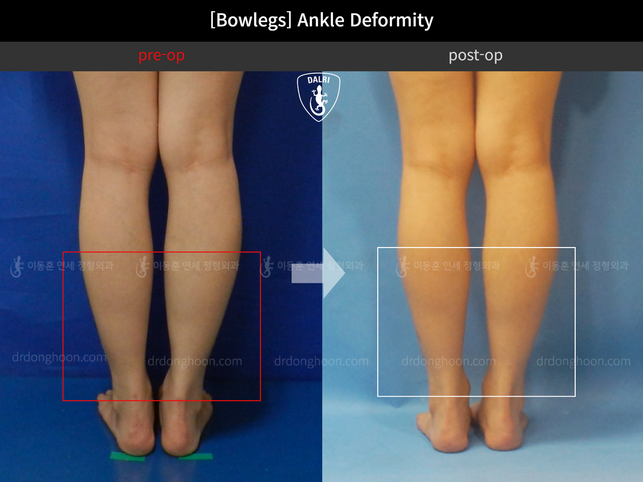 Before and after foot & ankle deformity, case 12754696, image 5, Dr. Donghoon institute (DALRI)