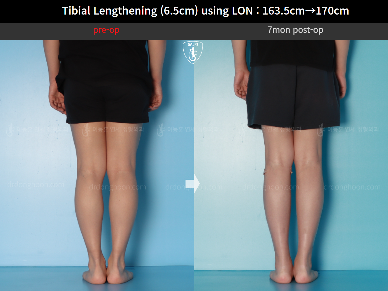 Before and after cll lon, case 17199046, image 6, Dr. Donghoon institute (DALRI)
