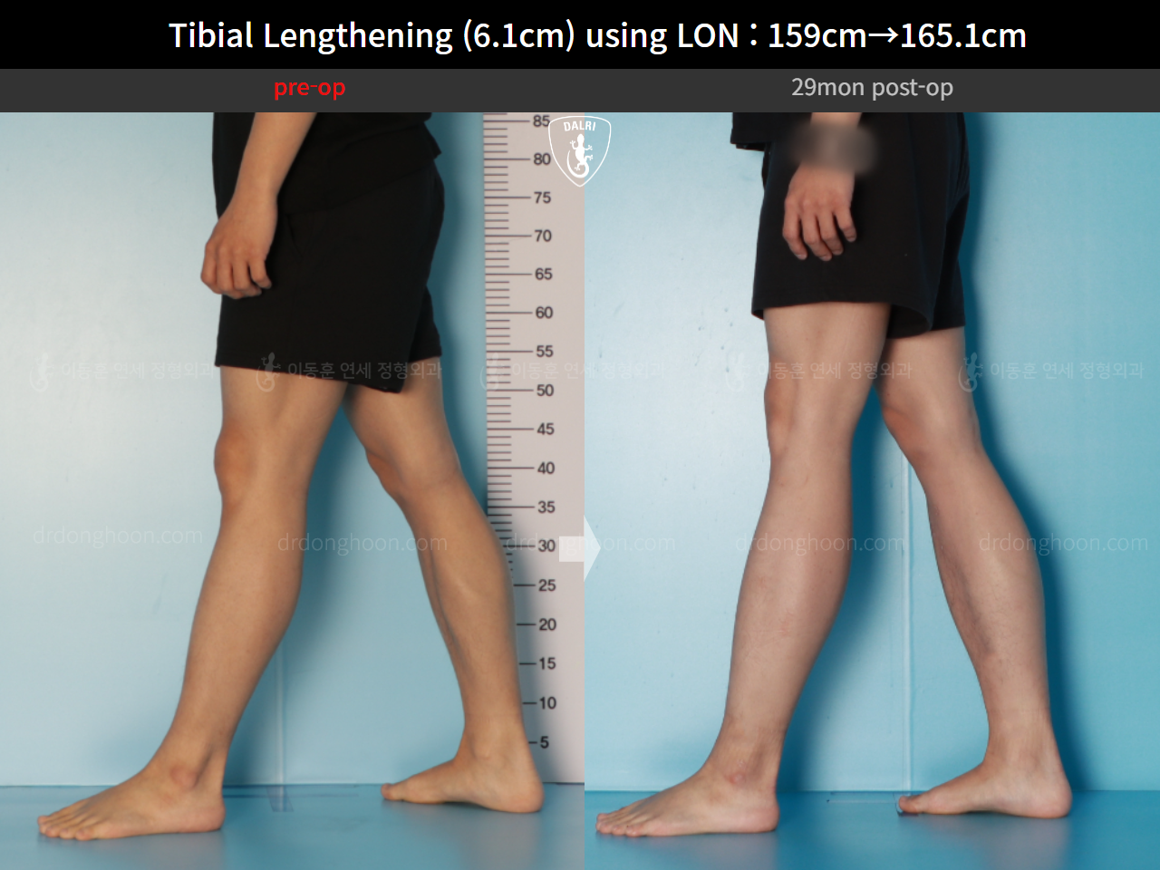 Before and after cll lon, case 16723424, image 10, Dr. Donghoon institute (DALRI)