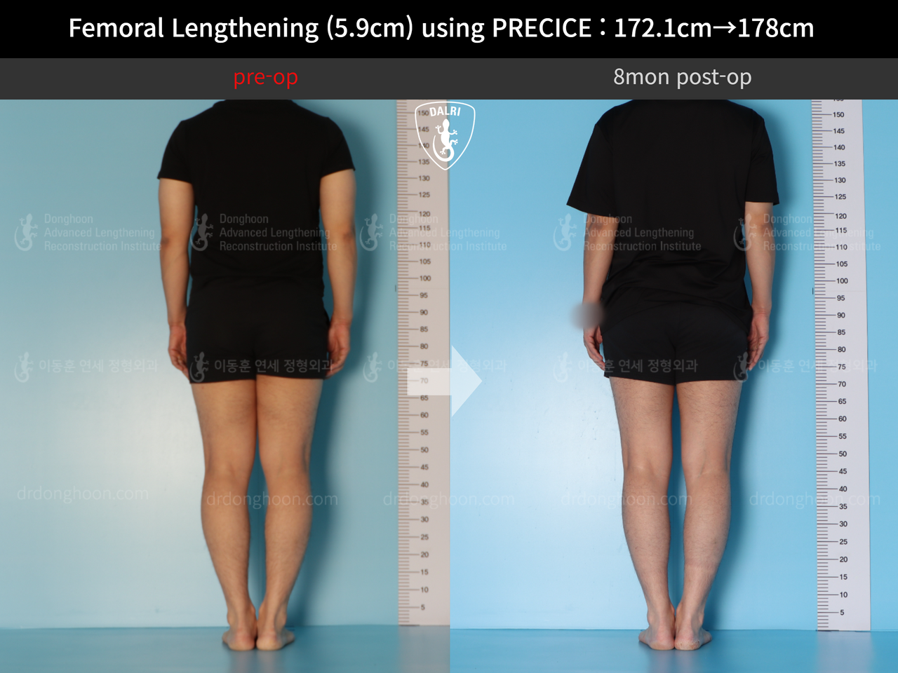 Before and after cll precice, case 13848850, image 4, Dr. Donghoon institute (DALRI)