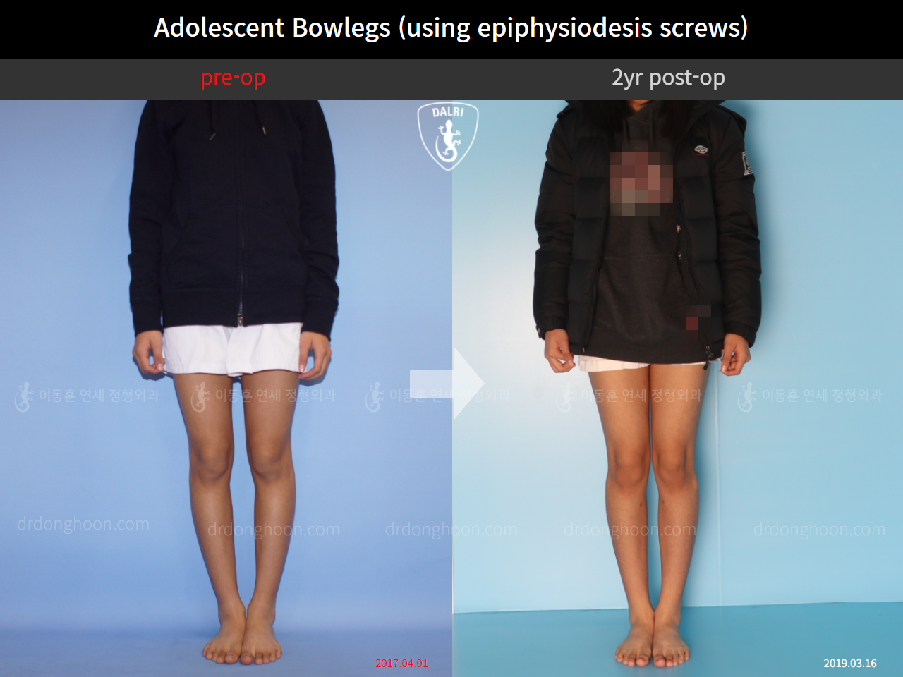 Before and after paediatric & adolescent bowlegs, case 4585777, image 1, Dr. Donghoon institute (DALRI)