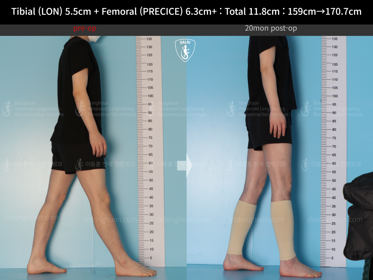 Before and after cll lon, case 14390077, image 5, Dr. Donghoon institute (DALRI)
