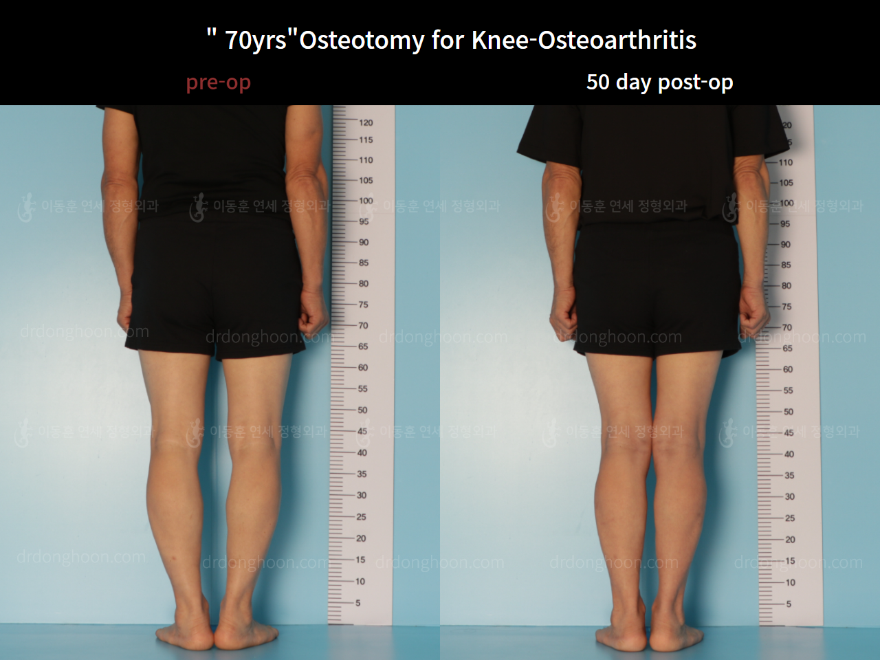 Before and after osteotomy for knee osteoarthritis, case 7753851, image 3, Dr. Donghoon institute (DALRI)