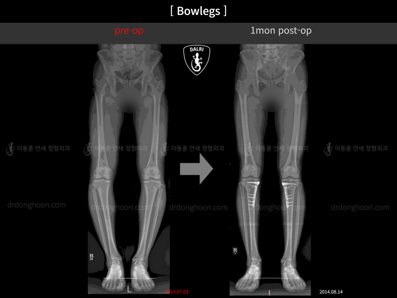 Before and after adult bowlegs, case 4311354, image 5, Dr. Donghoon institute (DALRI)