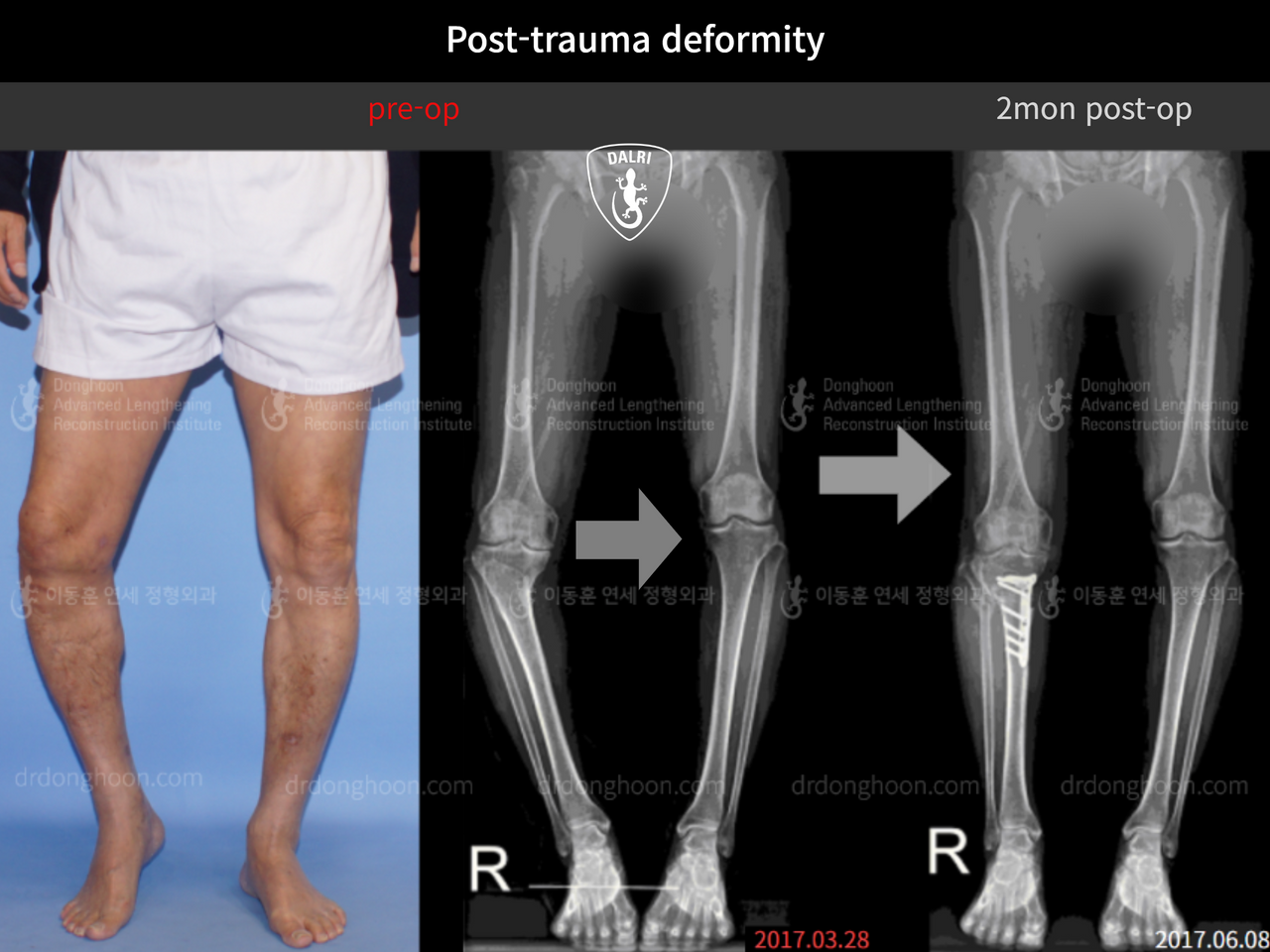 Before and after post-trauma deformity, case 12588834, image 1, Dr. Donghoon institute (DALRI)