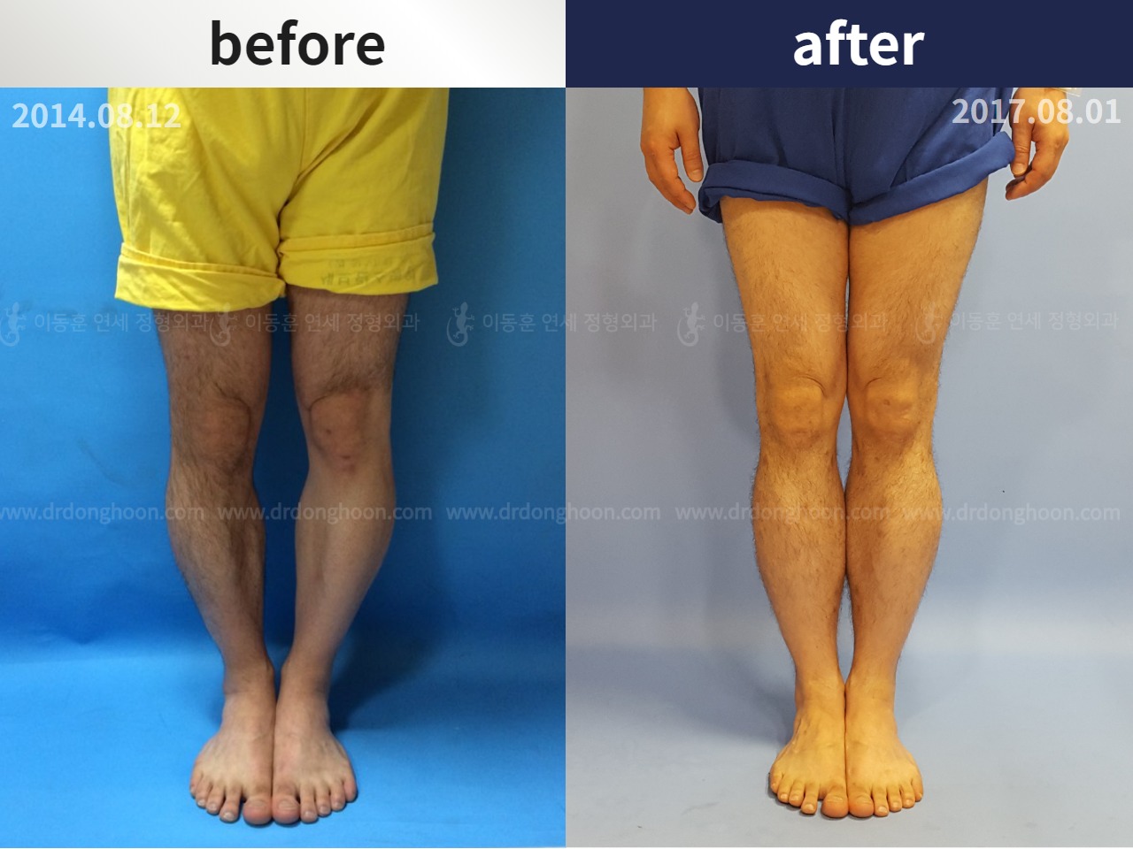 Before and after adult bowlegs, case 4311099, image 1, Dr. Donghoon institute (DALRI)