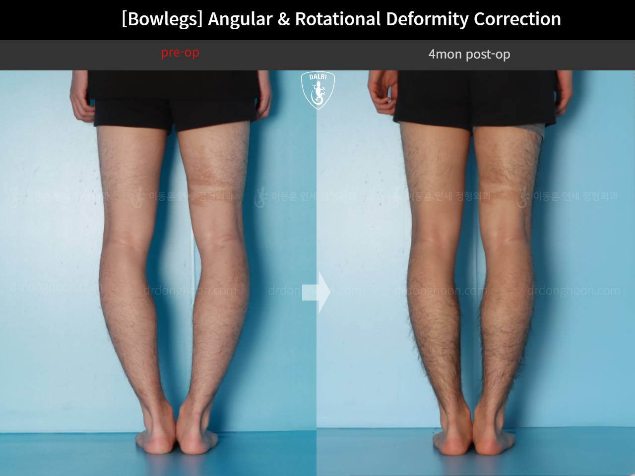 Before and after adult bowlegs, case 18071382, image 7, Dr. Donghoon institute (DALRI)