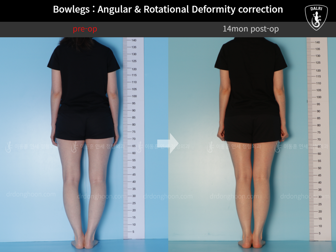 Before and after adult bowlegs, case 9557826, image 4, Dr. Donghoon institute (DALRI)