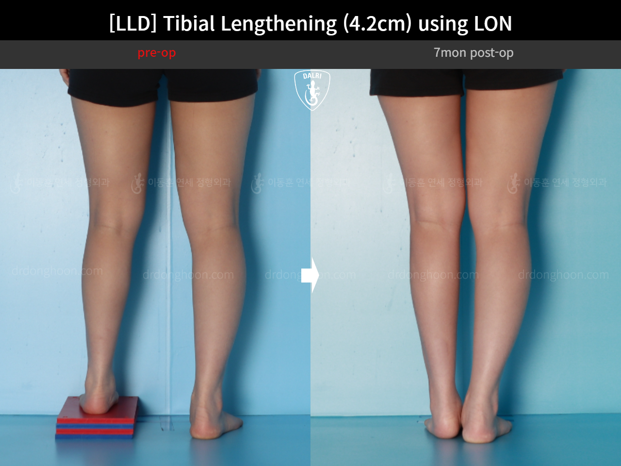 Before and after adult lld, case 16933852, image 7, Dr. Donghoon institute (DALRI)