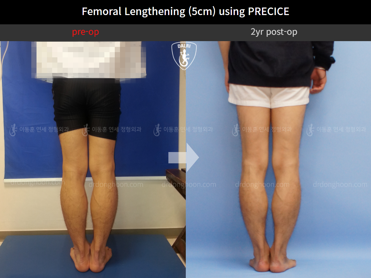 Before and after cll precice, case 4323372, image 5, Dr. Donghoon institute (DALRI)