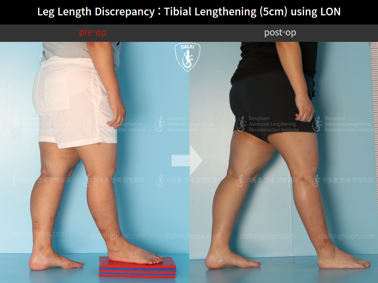 Before and after adult lld, case 9974673, image 6, Dr. Donghoon institute (DALRI)