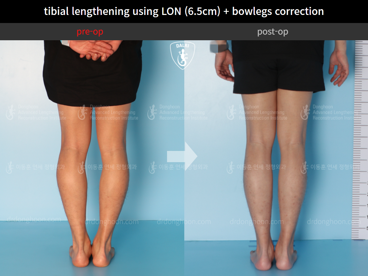 Before and after cll + deformity correction, case 4585639, image 6, Dr. Donghoon institute (DALRI)