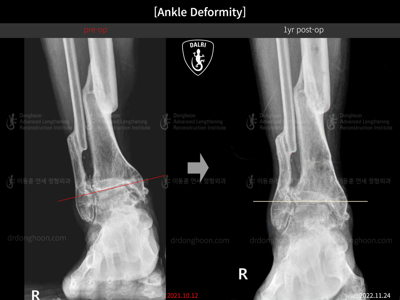 Before and after foot & ankle deformity, case 13580612, image 7, Dr. Donghoon institute (DALRI)
