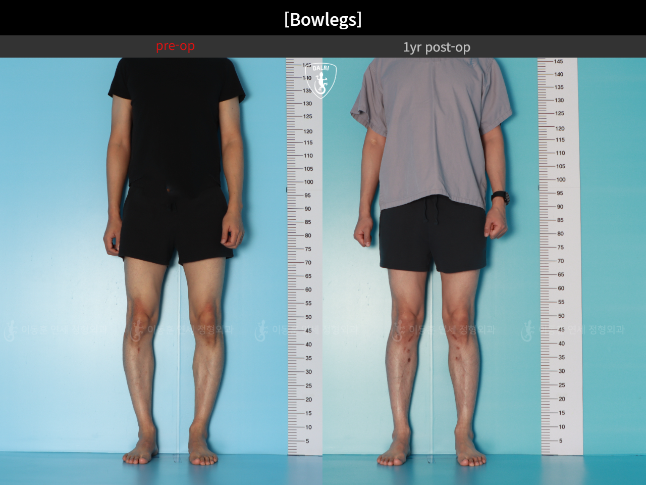 Before and after adult bowlegs, case 32564251, image 7, Dr. Donghoon institute (DALRI)
