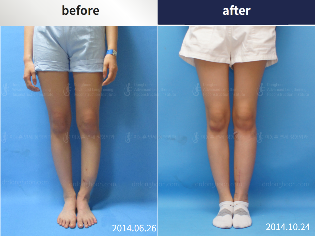 Before and after post-trauma deformity, case 4355008, image 1, Dr. Donghoon institute (DALRI)