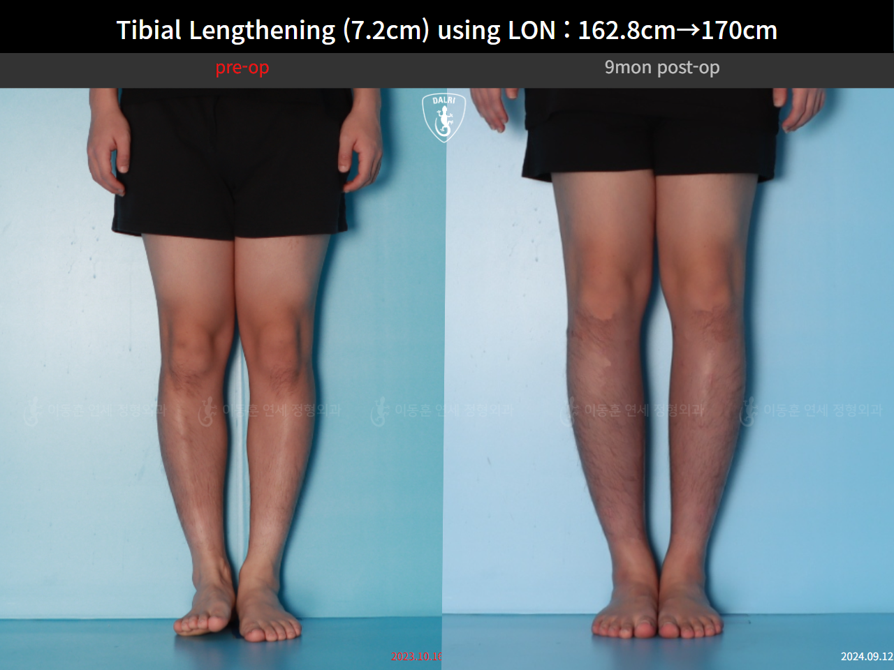 Before and after cll lon, case 124820559, image 5, Dr. Donghoon institute (DALRI)