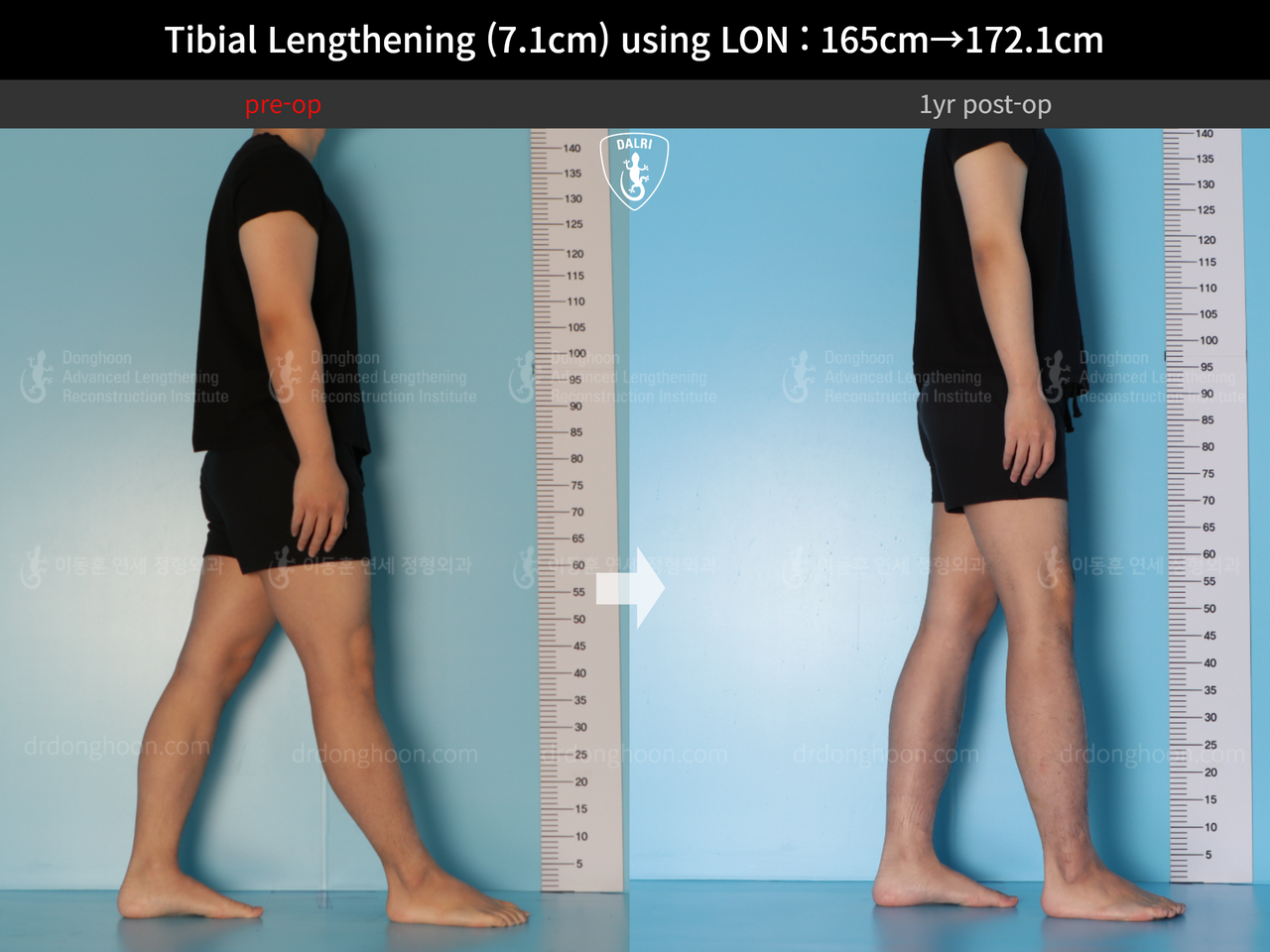 Before and after cll lon, case 14318674, image 3, Dr. Donghoon institute (DALRI)