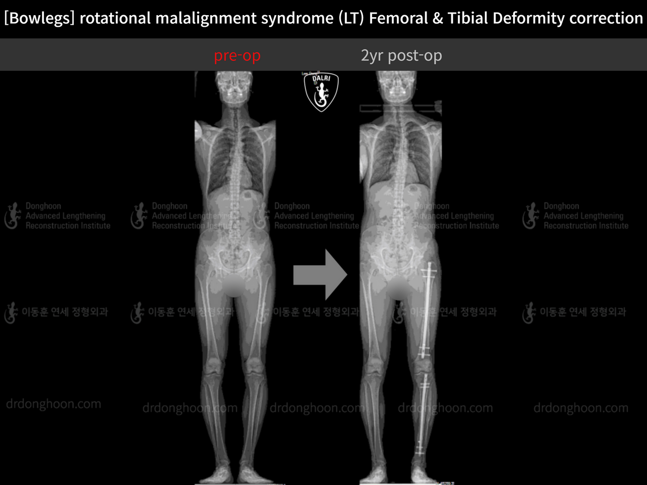 Before and after adult bowlegs, case 13266718, image 10, Dr. Donghoon institute (DALRI)