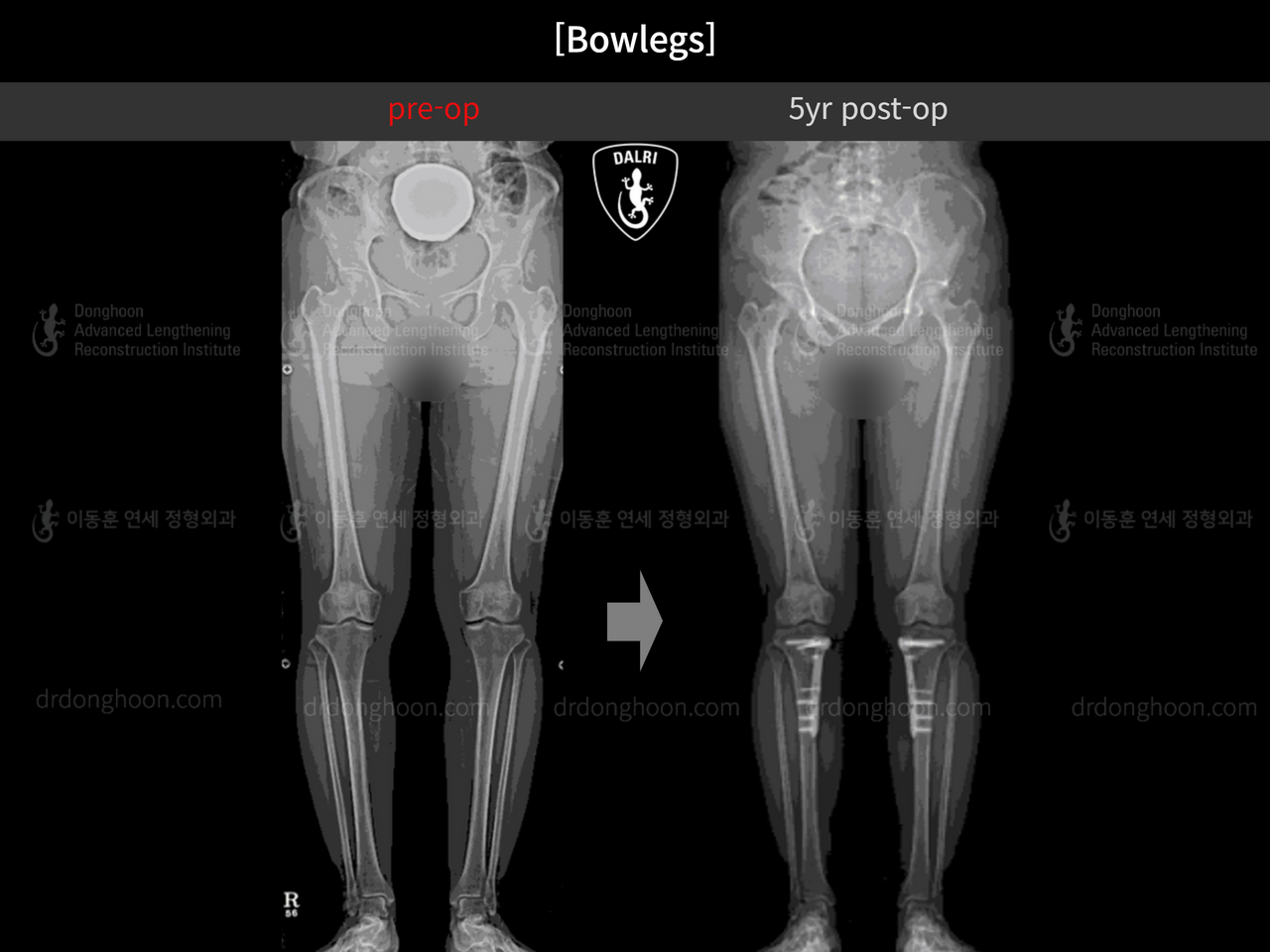 Before and after adult bowlegs, case 13567064, image 7, Dr. Donghoon institute (DALRI)