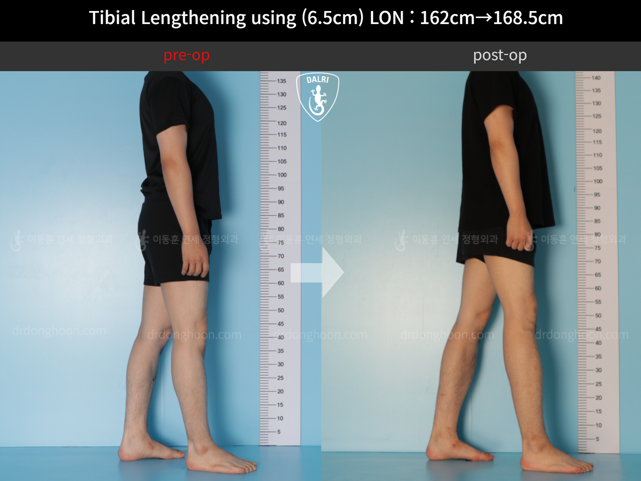 Before and after cll lon, case 11944171, image 3, Dr. Donghoon institute (DALRI)