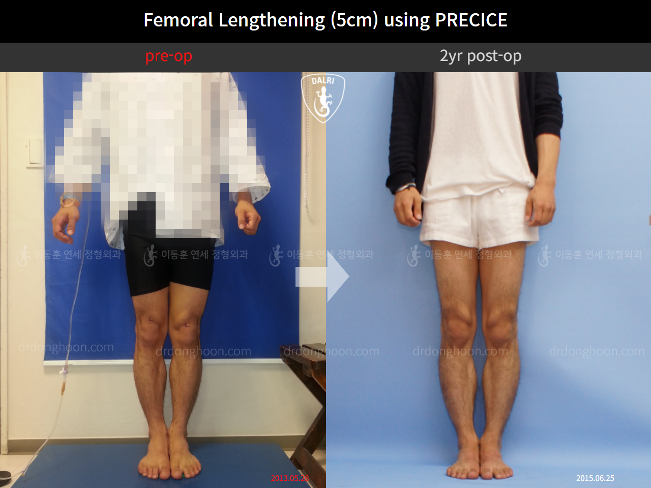Before and after cll precice, case 4323372, image 1, Dr. Donghoon institute (DALRI)