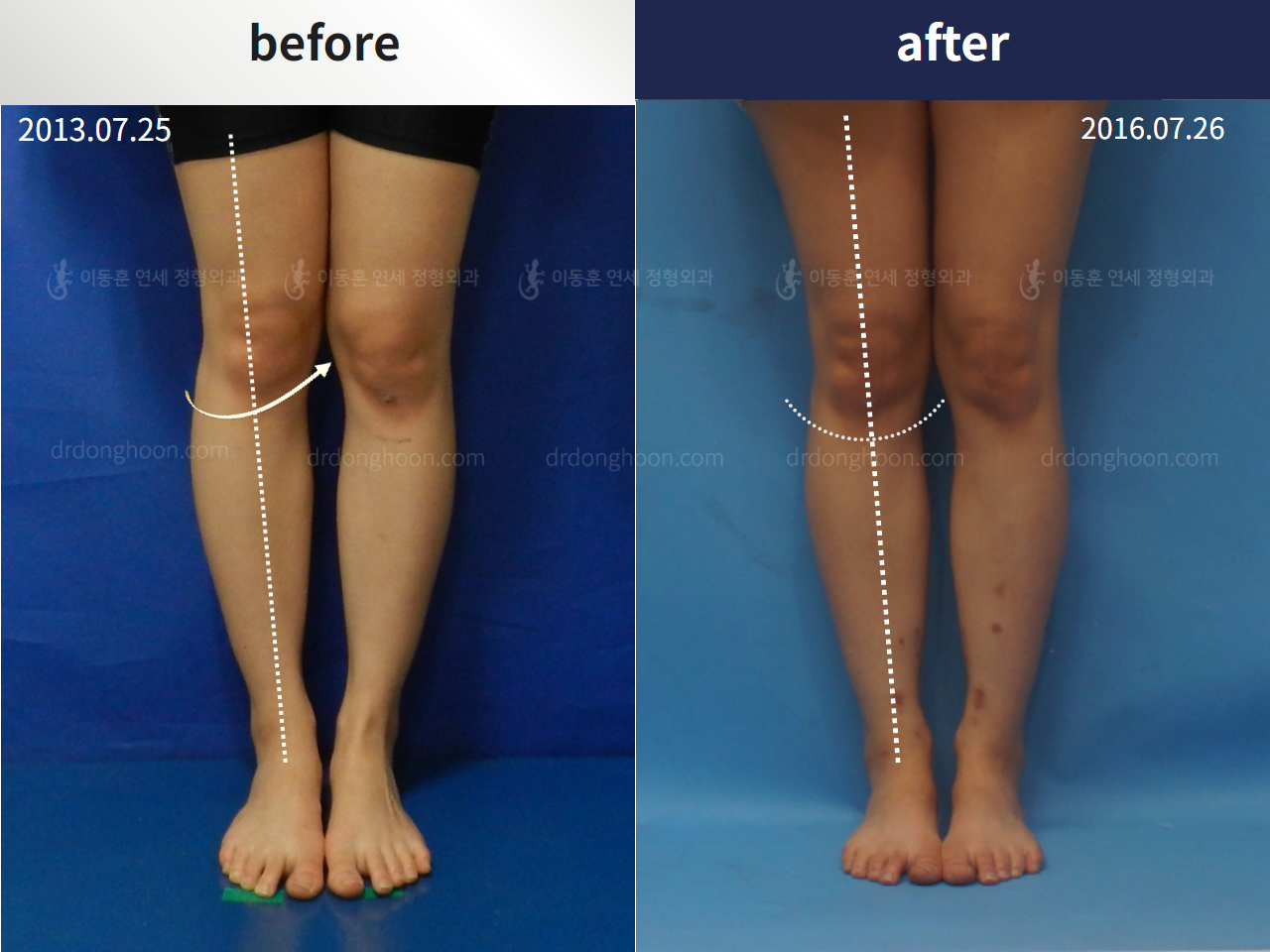 Before and after complex deformity, case 4251596, image 2, Dr. Donghoon institute (DALRI)