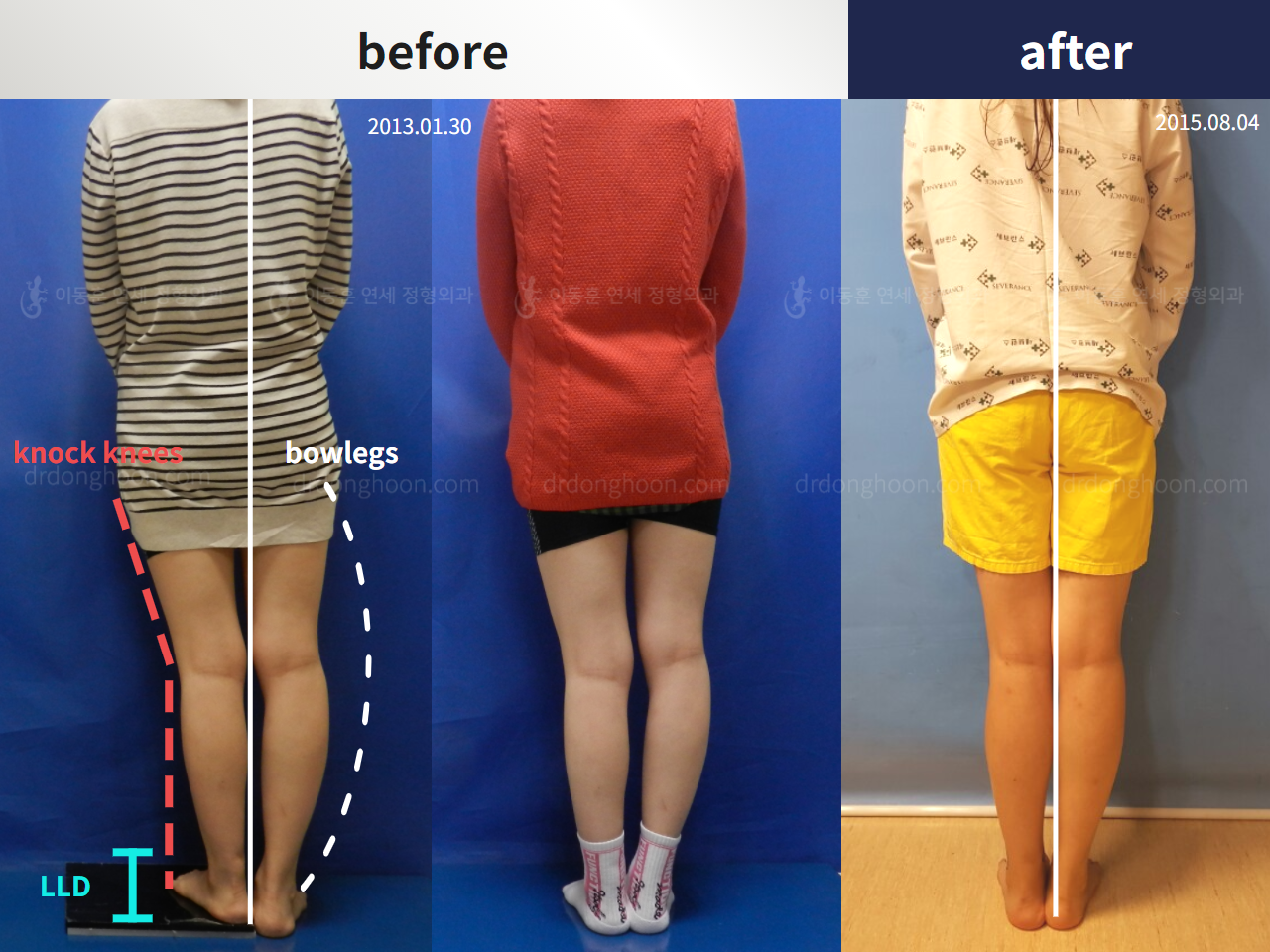Before and after adult lld, case 5315259, image 3, Dr. Donghoon institute (DALRI)