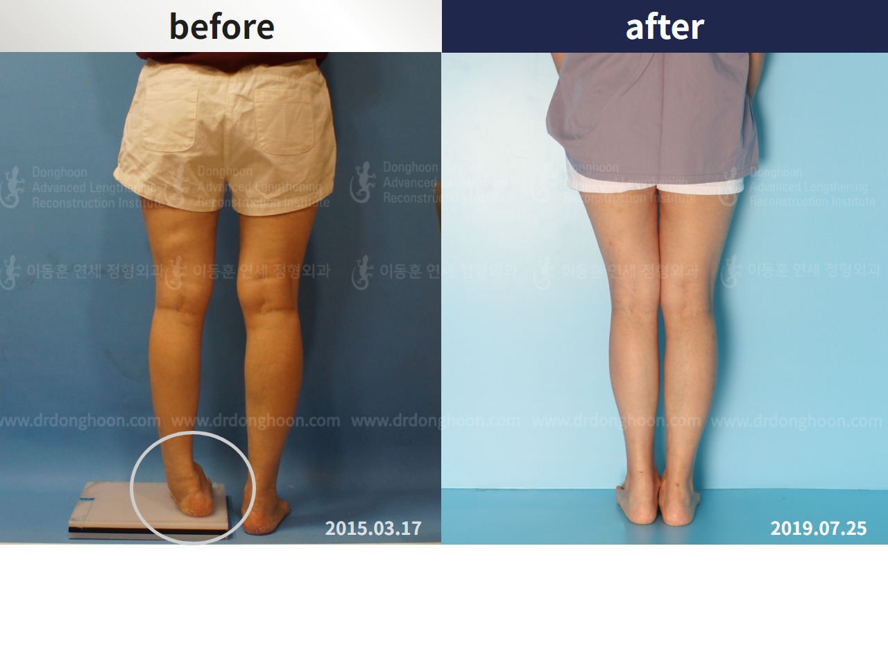 Before and after adult lld, case 4320344, image 3, Dr. Donghoon institute (DALRI)
