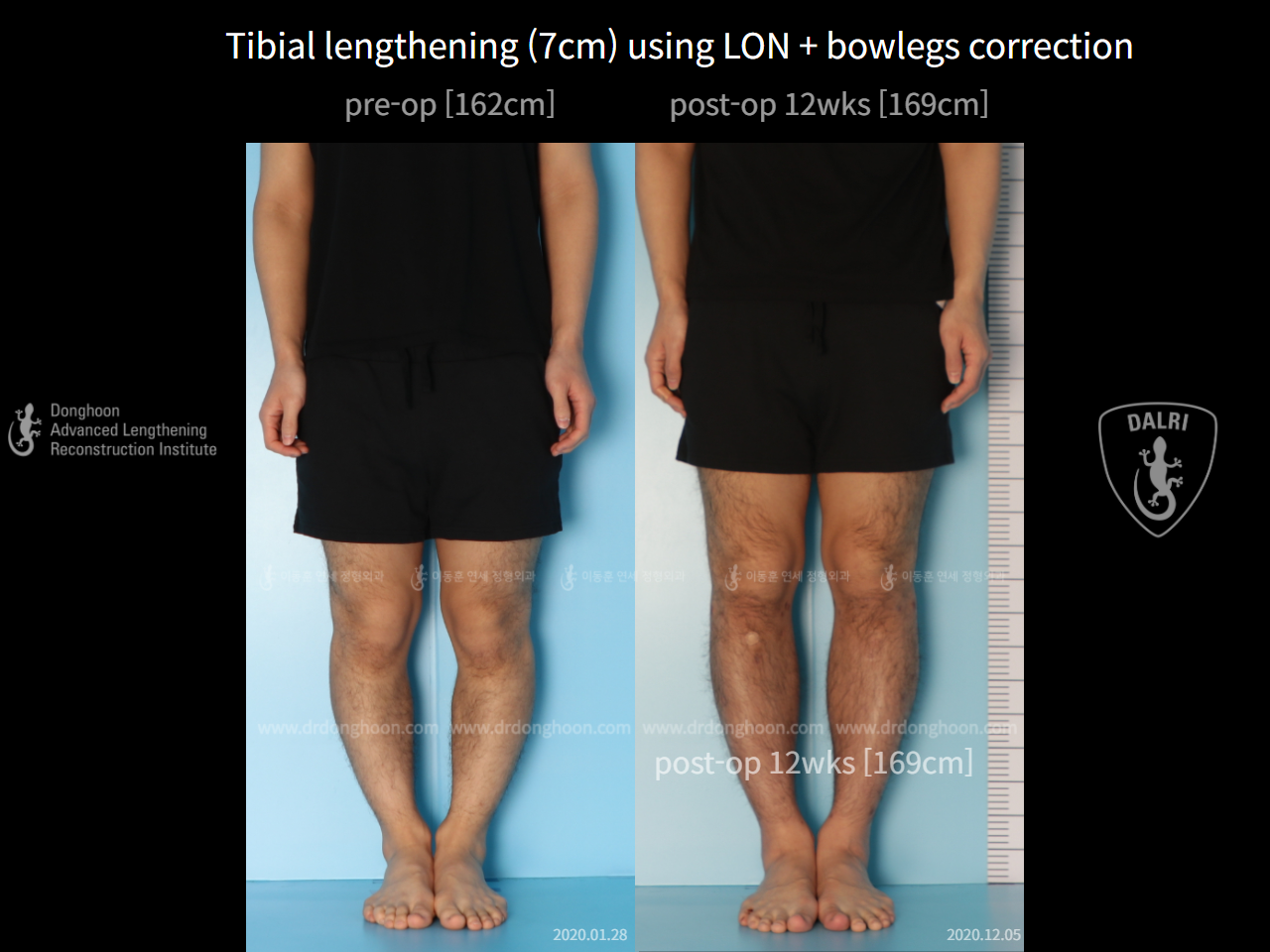 Before and after cll + deformity correction, case 6740433, image 4, Dr. Donghoon institute (DALRI)
