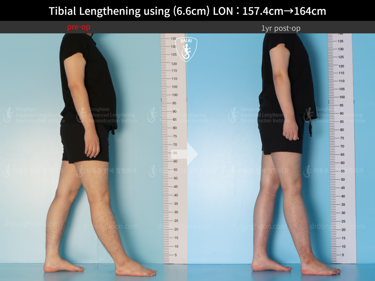 Before and after cll lon, case 13418098, image 3, Dr. Donghoon institute (DALRI)