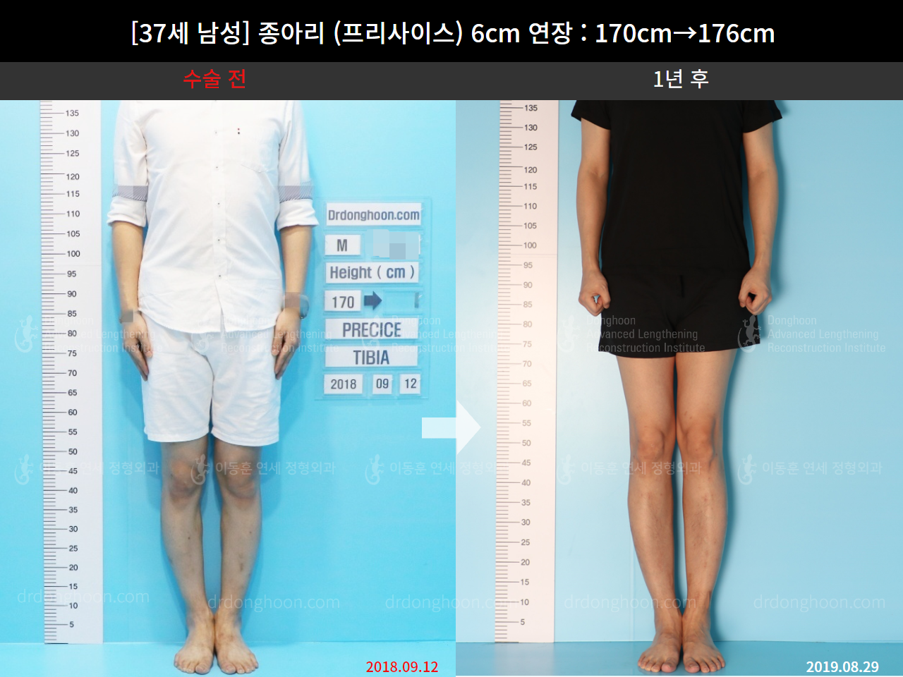 Before and after cll precice, case 4573549, image 1, Dr. Donghoon institute (DALRI)