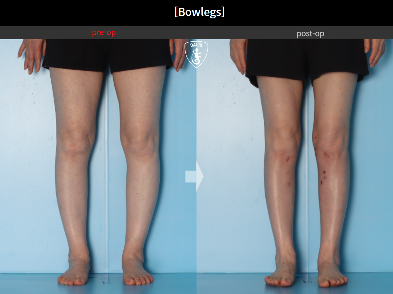 Before and after adult bowlegs, case 30256399, image 10, Dr. Donghoon institute (DALRI)