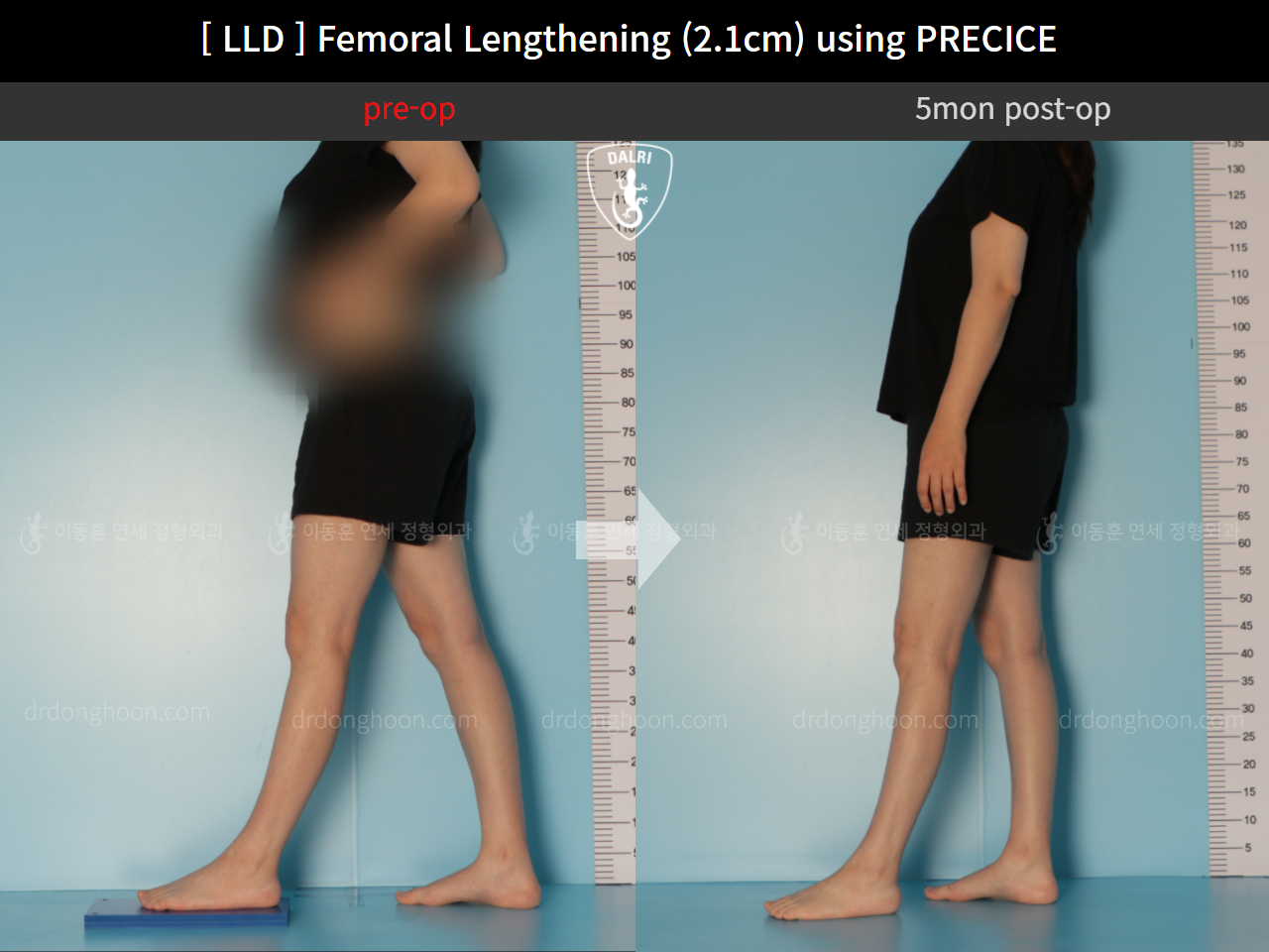 Before and after adult lld, case 11784618, image 3, Dr. Donghoon institute (DALRI)