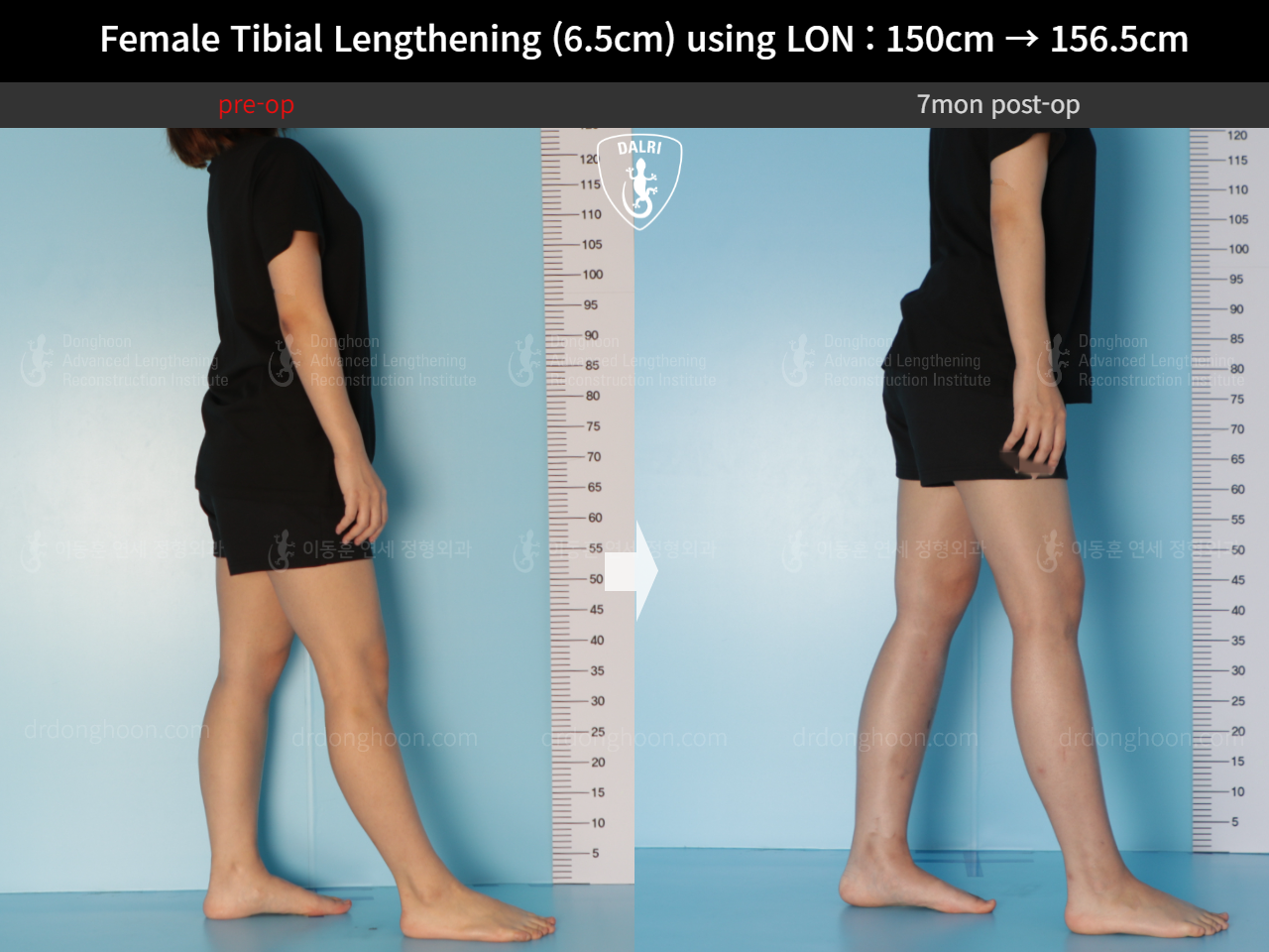 Before and after cll lon, case 16061220, image 4, Dr. Donghoon institute (DALRI)