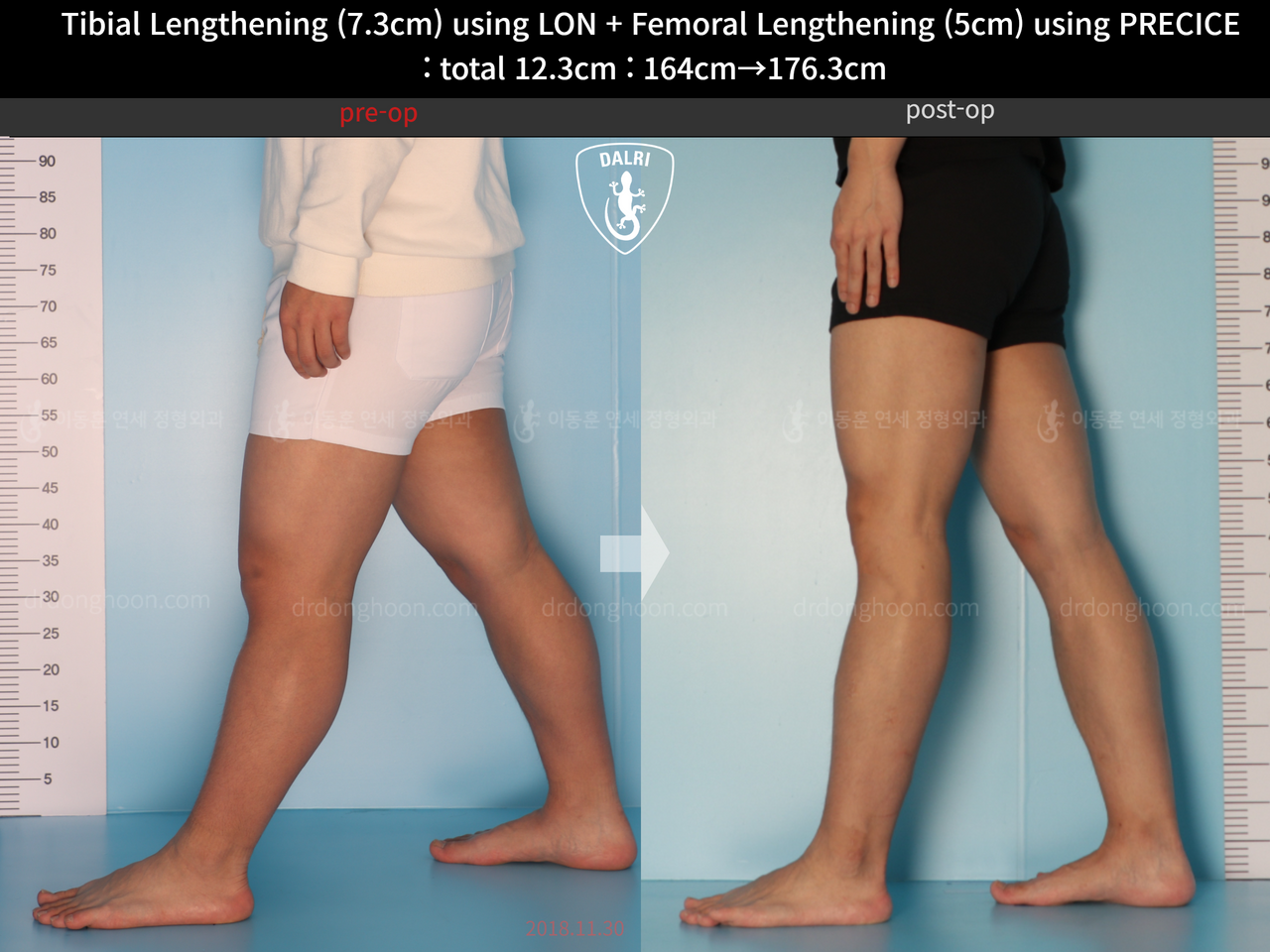 Before and after cll precice, case 13590455, image 7, Dr. Donghoon institute (DALRI)