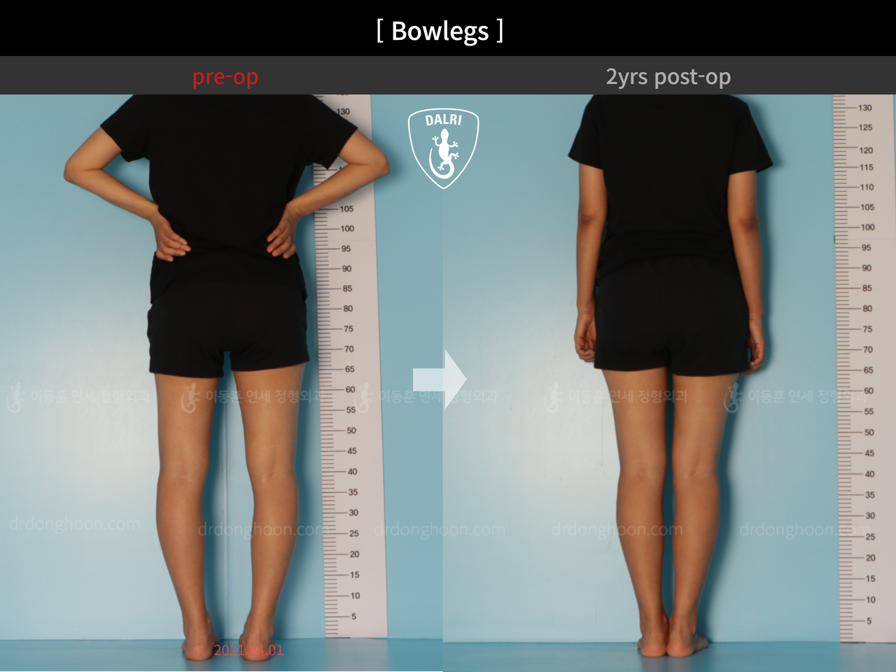 Before and after adult bowlegs, case 12060396, image 4, Dr. Donghoon institute (DALRI)