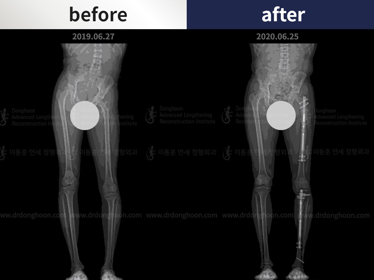 Before and after paediatric & adolescent lld, case 4684461, image 4, Dr. Donghoon institute (DALRI)