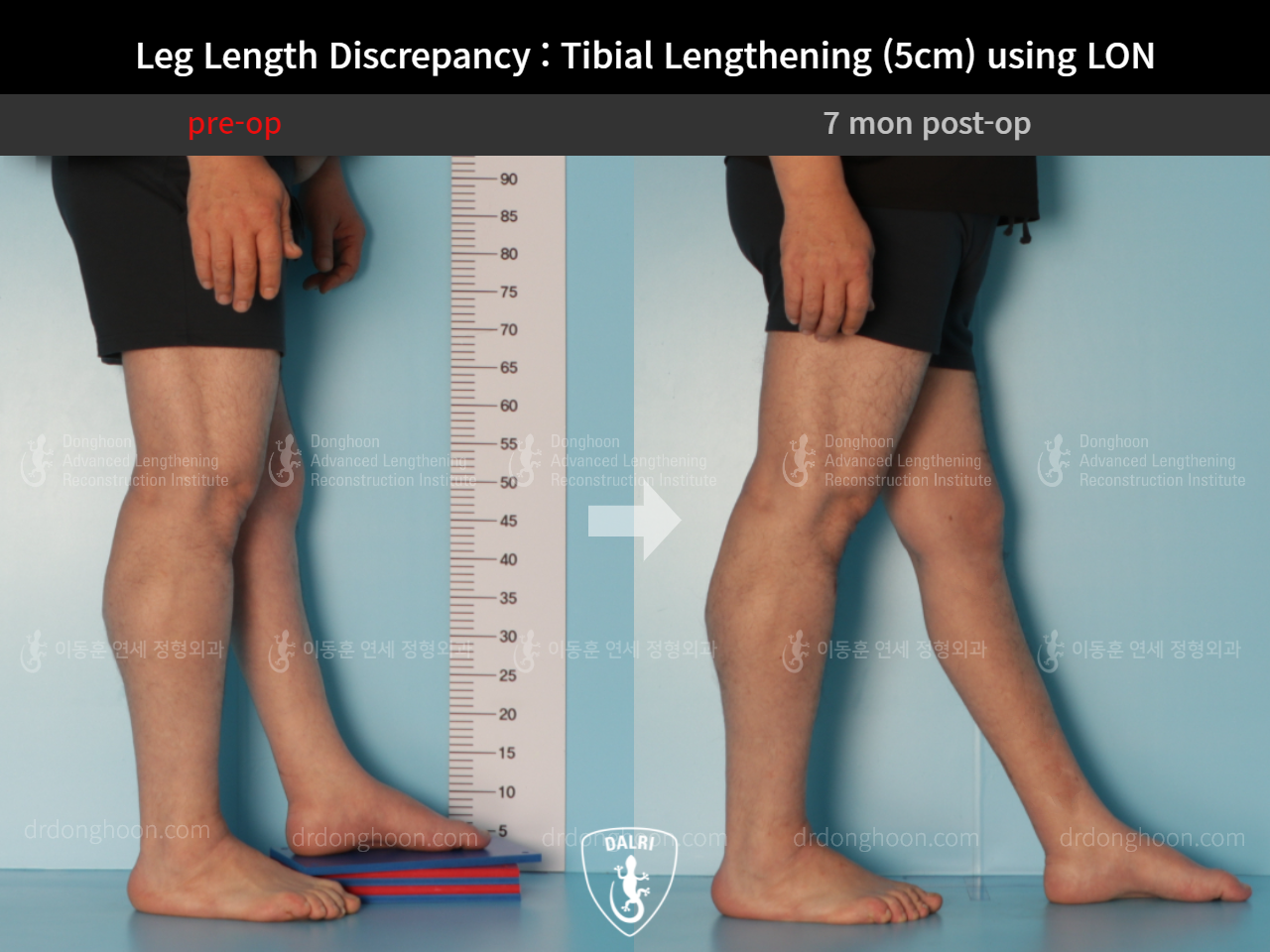 Before and after adult lld, case 9165807, image 8, Dr. Donghoon institute (DALRI)