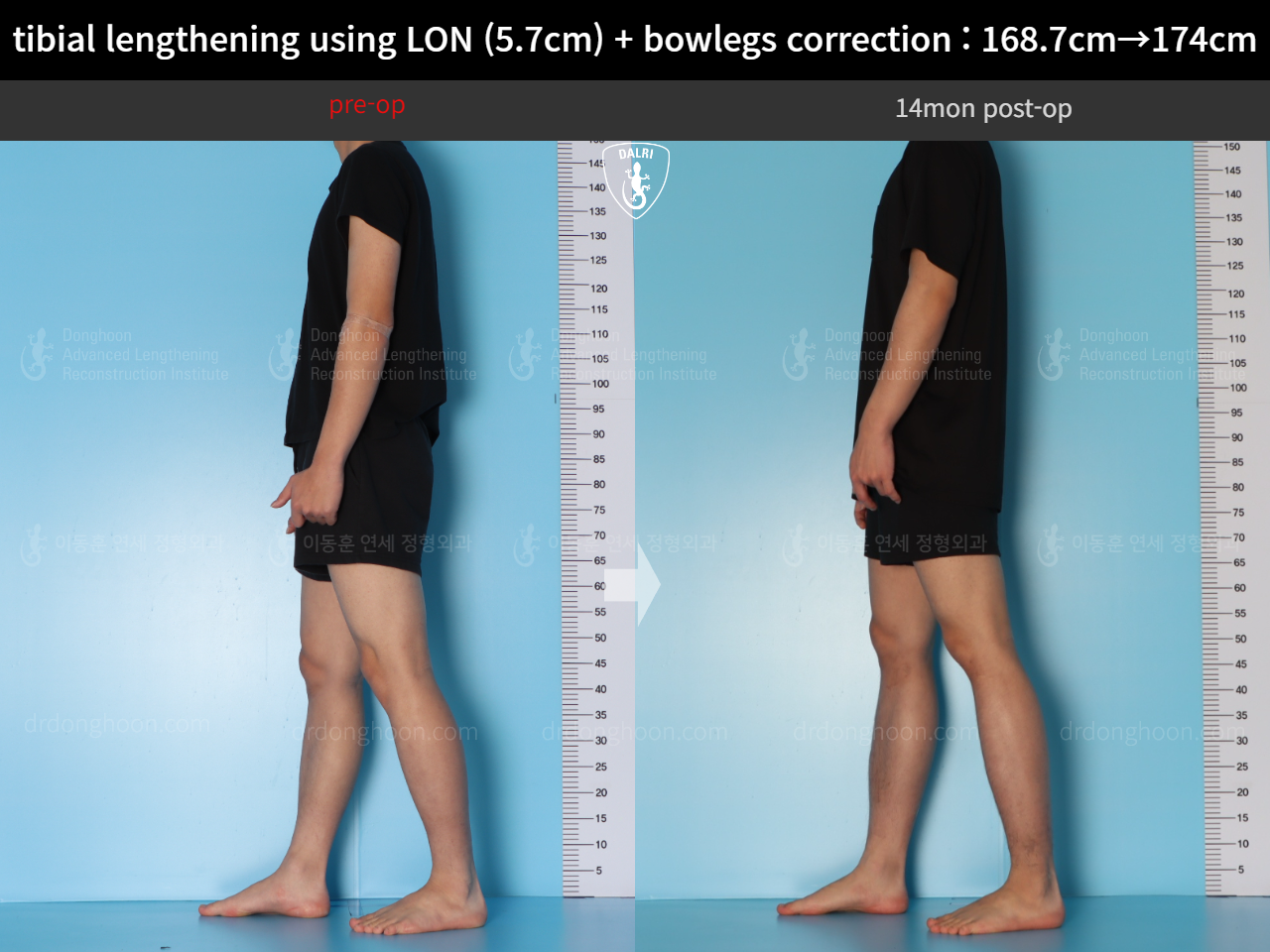 Before and after cll + deformity correction, case 18160780, image 5, Dr. Donghoon institute (DALRI)