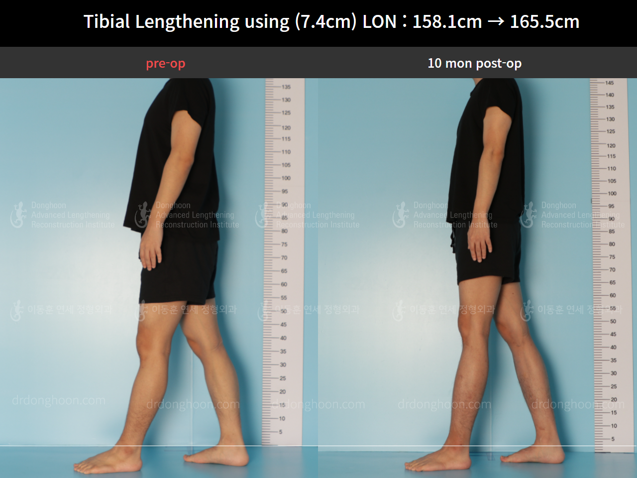 Before and after cll lon, case 8559634, image 4, Dr. Donghoon institute (DALRI)